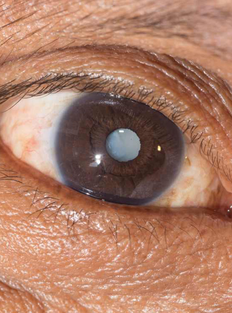 Cataract: diagnosis & treatment